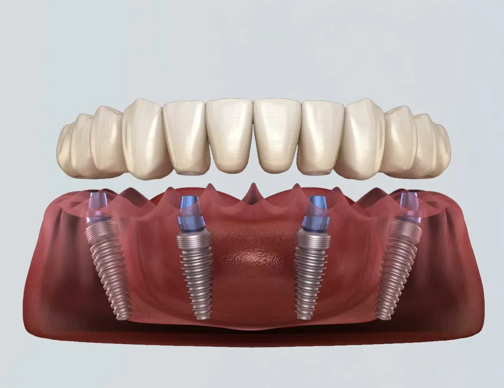 All on 4 implants