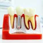 Dental implants Palmdale