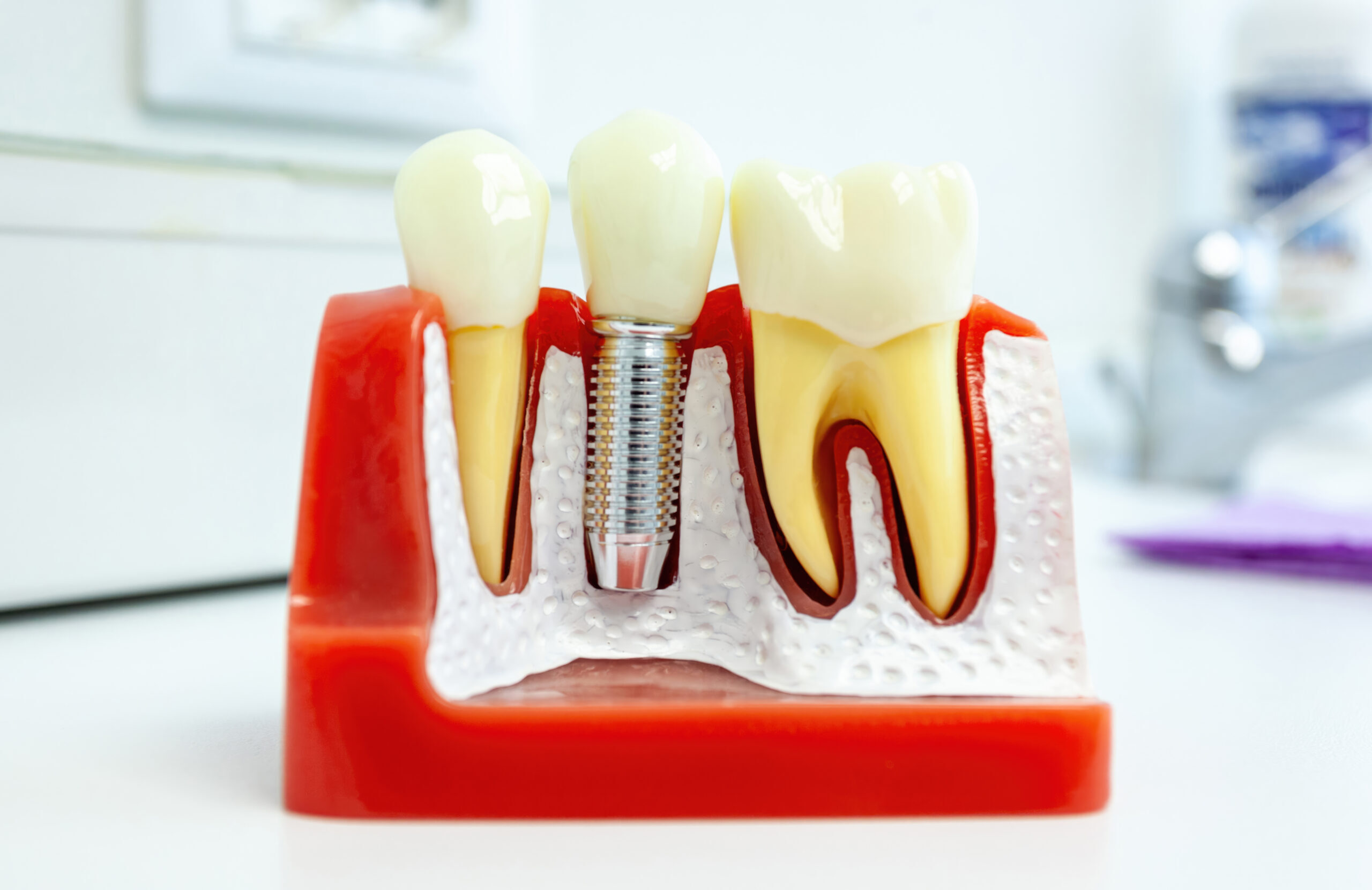 Can Dental Implants in Palmdale Replace Teeth Lost Years Ago?